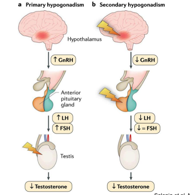 <p>Hypogonadism in XY</p><ul><li><p>decreased functional activity of the testes</p></li><li><p>decreased production of androgens, inhibin B, AMH and/or impaired sperm production</p></li></ul><p></p><p>Primary hypogonadism</p><ul><li><p>main effect at the testis</p></li><li><p>Decreases testosterone</p></li><li><p>Therefore, increase LH and FSH production (because there is no negative control system)</p></li></ul><p></p><p>Secondary hypogonadism</p><ul><li><p>main effect at the brain CNS</p></li><li><p>Which decreases GnRH</p></li><li><p>Which then decreases the LH, FSH, and testosterone</p></li><li><p>Solution</p><ul><li><p>Add exogenous testosterone</p></li><li><p>However the decrease in LH and FSH is also a problem because you need them for fertilization purposes</p><ul><li><p>Increase in LH and FSH is better</p></li></ul></li></ul></li></ul><p></p>
