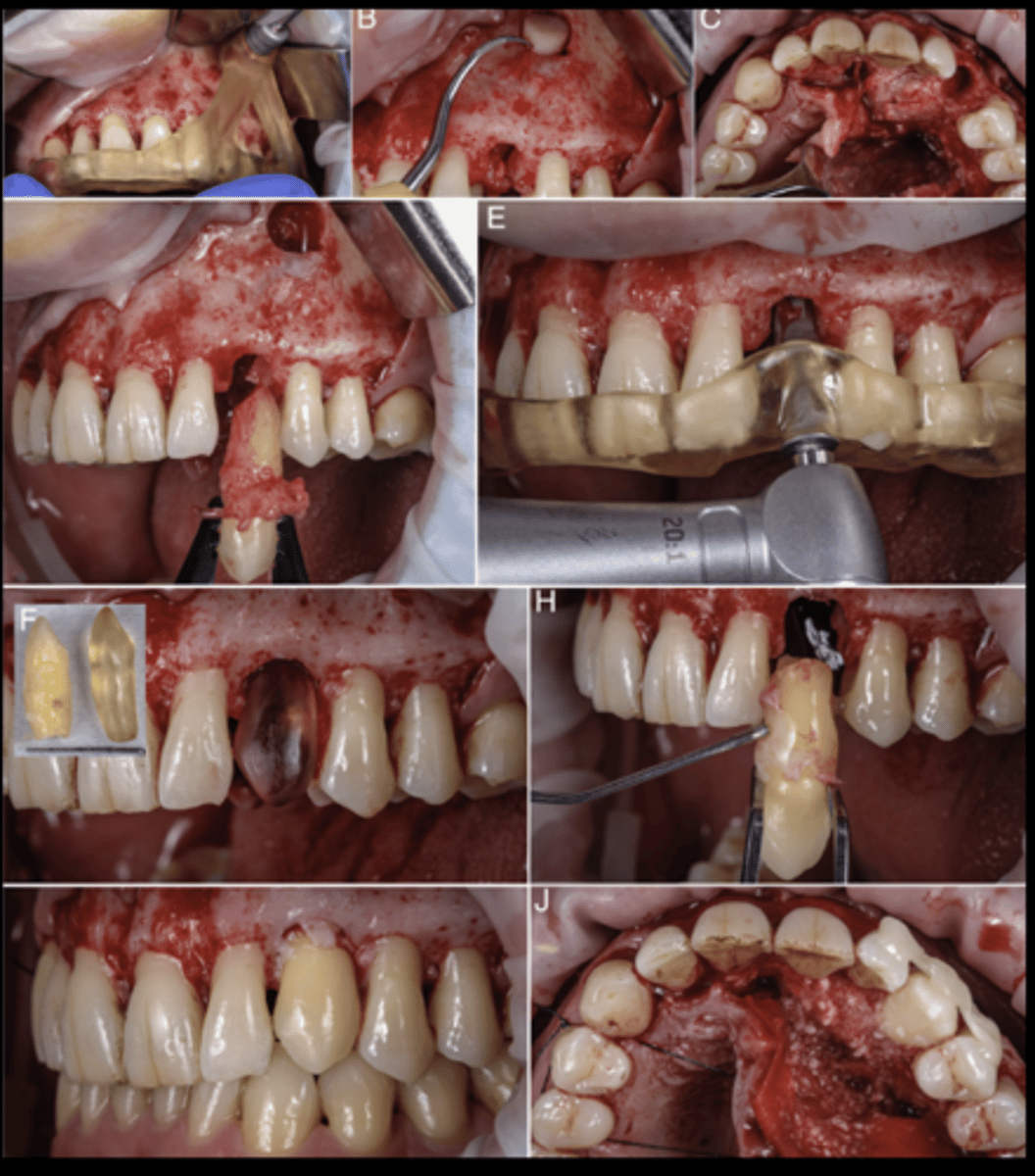 <p>Autotransplantation</p>