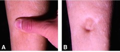 <p>What could be the most likely cause(s) of the problem seen in this leg?</p>