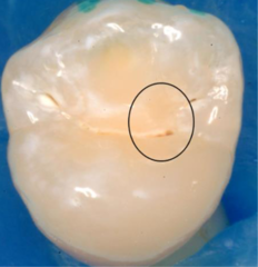 <p>What ICDAS score would be given to this tooth?</p>