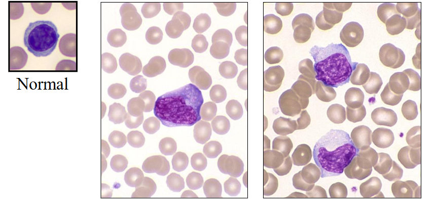 <p>- large activated lymphocytes with irregularly shaped nuclei; abundant flowing basophilic cytoplasm with a dark-staining periphery</p>