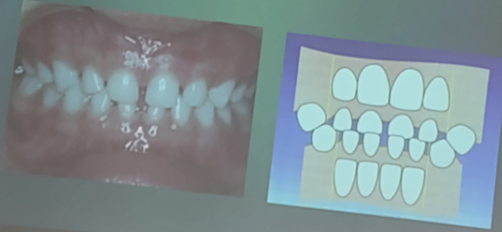 <p><span style="background-color: transparent;">Pequeños espacios entre diente y diente que se presentan de forma generalizada estando situados frecuentemente en la zona incisiva</span></p>