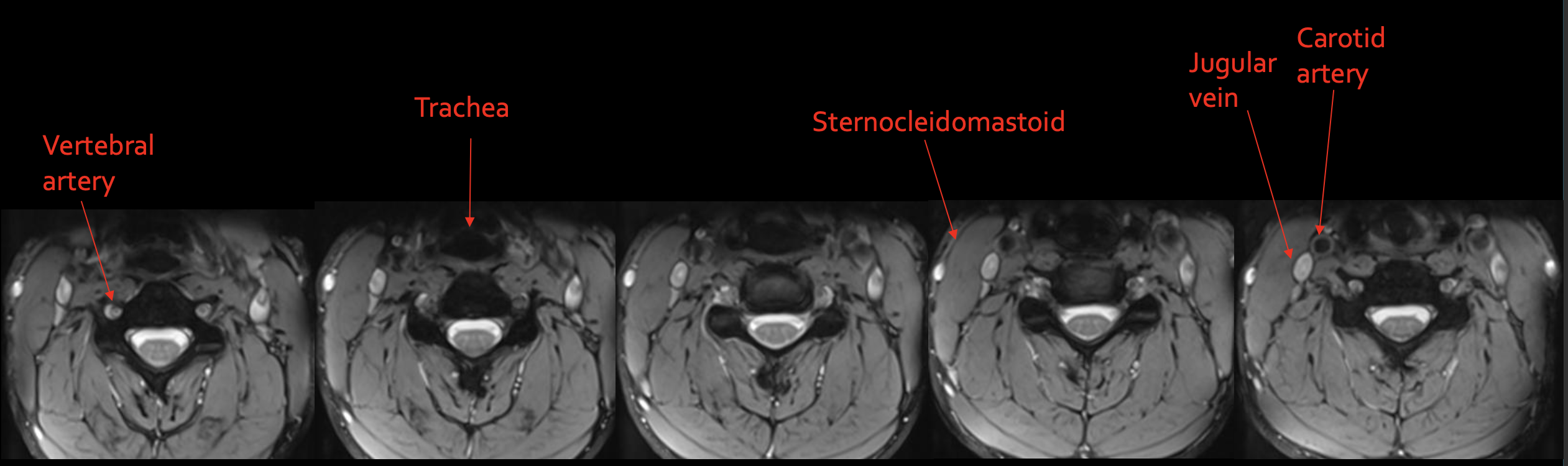 <p><strong>Vertebral artery</strong></p>