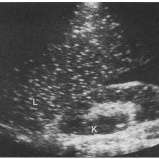 <ul><li><p>diffuse tiny non-shadowing echogenic foci </p></li><li><p>replacement of liver parenchyma by echogenic clumps of Ca +2</p></li></ul><p></p>