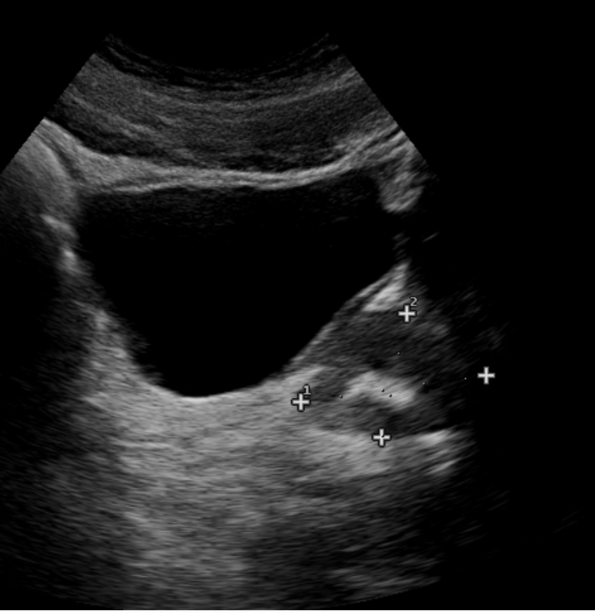 <p>The findings on the image are most suggestive of:</p><p class="p1">A. Enlarged seminal vesicle</p><p class="p1">B. Normal seminal vesicle</p><p class="p1">C. Normal sized prostate with echogenic appearance of the central sinus related to the hypoechoic outer cortex</p><p class="p1">D. Normal sized prostate with a corpora amylacea.</p>