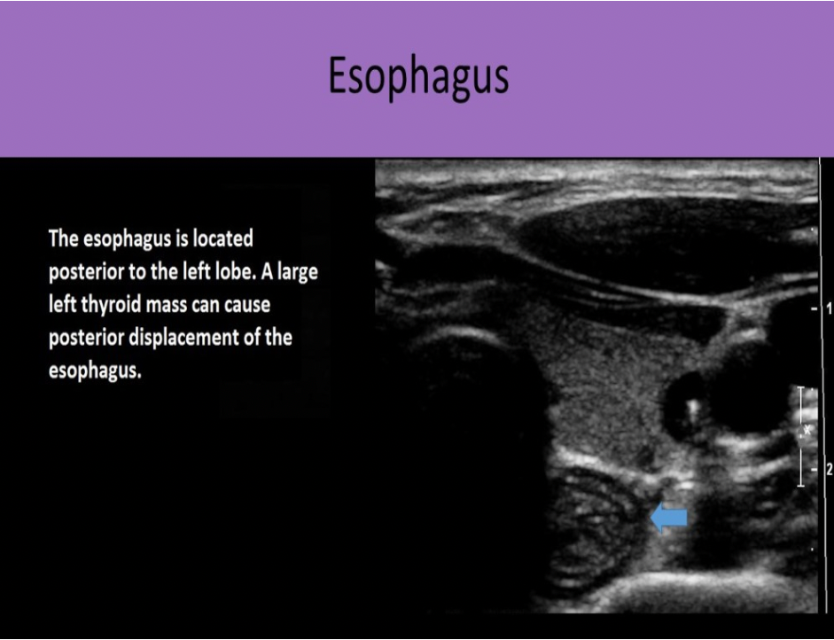 <p>C. Esophagus</p><p>The strap muscles and the omohyoid muscle, one of the strap muscles, are anterior to the gland. The sternocleidomastoid muscles are anterior and lateral.</p><p class="p1">The longus colli muscles are on either side of the spine, posterior to the thyroid lobes. The esophagus is posterior and medial to the left thyroid lobe.</p>