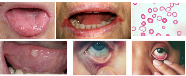 <p></p><p>•Atrophic glossitis with smooth glossy tongue</p><p>•Angular cheilitis at commissures common finding</p><p>•Burning tongue symptoms may be reported</p><p>•Oral mucosa appears pale on examination</p><p>•Increased risk of candidiasis infections</p><ul><li><p>generally not good if male presents, could indicate more serious implications such as a GI bleed </p></li></ul><p></p>