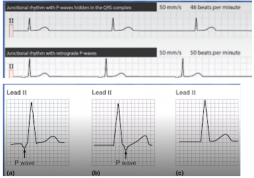 <ul><li><p><span style="background-color: transparent;">Pacemaker in the AV junction of bundle of HIS region&nbsp;</span></p></li><li><p><span style="background-color: transparent;">Electrical impulse travels backwards to depolarise atria so if p wave is seen it is inverted</span></p></li><li><p><span style="background-color: transparent;">Normal rate = 40-60bpm</span></p><ul><li><p><span style="background-color: transparent;">>60 = accelerated junctional</span></p></li><li><p><span style="background-color: transparent;">>100 = junctional tachycardia</span></p></li><li><p><span style="background-color: transparent;"><40 = junctional escape</span></p></li></ul></li></ul><ul><li><p><span style="background-color: transparent;">Heart rate: 40-60bpm</span></p></li><li><p><span style="background-color: transparent;">Rhythm: regular</span></p></li><li><p><span style="background-color: transparent;">P waves: inverted or missing</span></p></li><li><p><span style="background-color: transparent;">PR interval: unknown</span></p></li><li><p><span style="background-color: transparent;">QRS complex: narrow <0.12 seconds</span></p></li></ul><p></p>