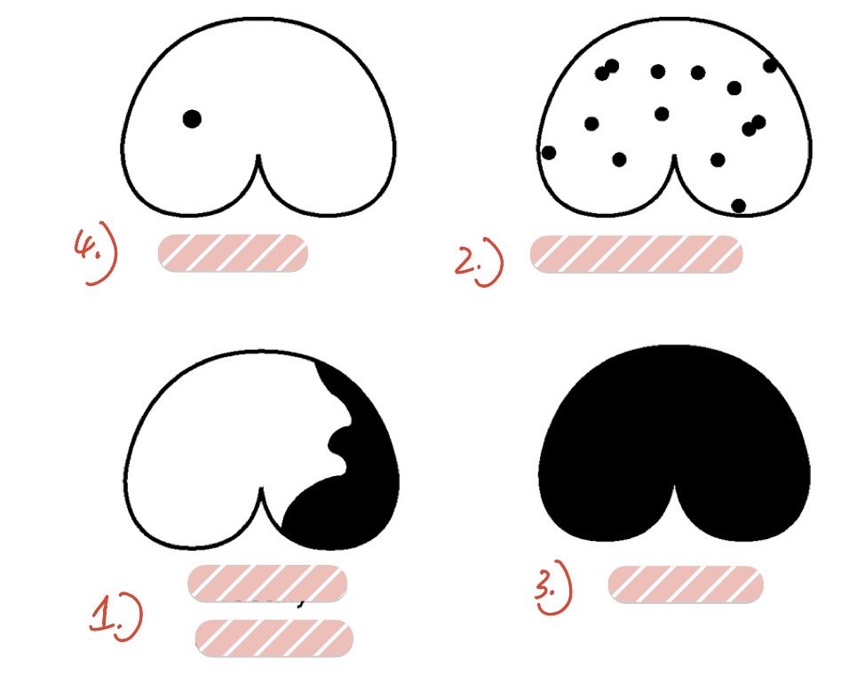 <p>name the distributions of disease provided by the picture </p>