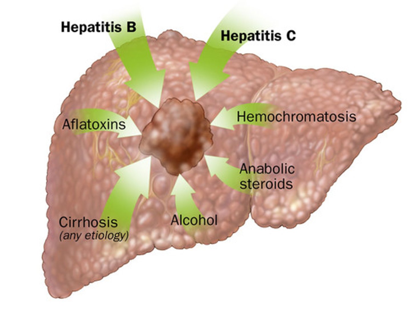 <p>hepatocellular carcinoma</p>