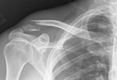 <p>Parts of the bone are completely separated</p>