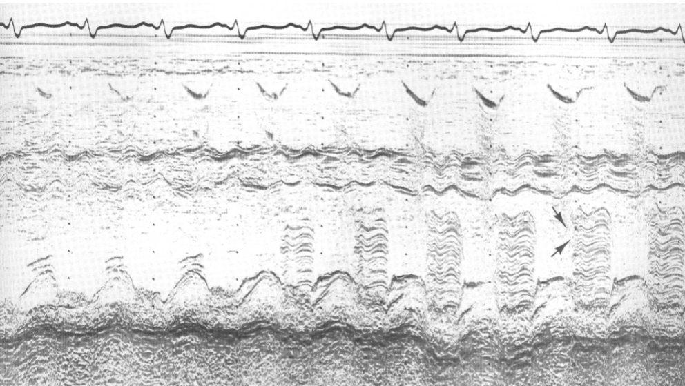<ul><li><p>blunted E-point of MV</p></li><li><p>reduced E-F slope</p><ul><li><p>can mimic MS</p></li></ul></li><li><p>heavy band of echoes behind AMVL in diastole</p></li></ul><p></p>