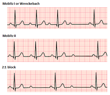 <ul><li><p>AV node fails to trasmit all atrial impulses </p><ul><li><p>more P waves than QRS complexes</p></li></ul></li><li><p>atria beat more than once for each ventricular contraction</p></li></ul><p></p>