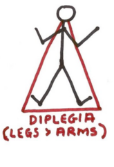 <p>paralysis of corresponding parts on both sides of the body (more common in legs than arms)</p>