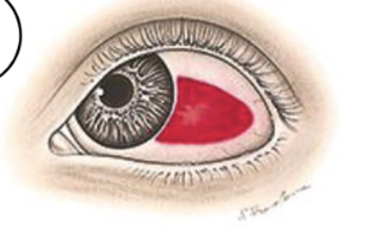 <p>Leakage of blood outside of the vessels, producing a homogeneous, sharply demarcated, red area that resolves over 2 wks</p><p>No pain</p><p>Vision unaffected</p><p>Not significant</p>