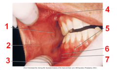 <p>Small elevation of tissue located on the inner surface of the cheek. #1</p>