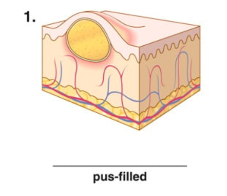<p>pus filled</p>