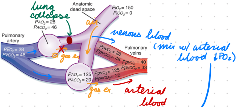 <p>From ventilation blockage (lung collapse in atelectasis)</p><p>Venous blood bypass one gas-exchange unit to mix with arterial</p><p>Low V, normal Q</p><ul><li><p>V/Q < 0.80</p></li></ul><p></p>
