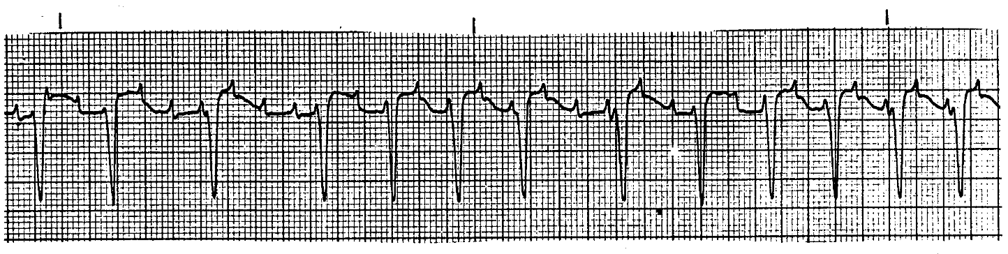<p>What ECG is this</p>