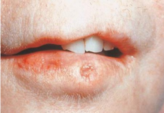 <p>Dominant non-syndromic CL/P, lip pits. Normal intelligence but may struggle with language acquisition, even after repair.</p>