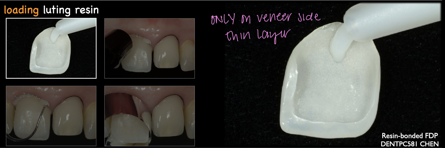 <p>thin layer on the veneer side </p>