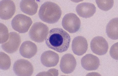 <p>a. diffuse cerebral dz</p><p>b causes aggression, convulsions, central blindness, wandering, head pressing, opisthotonos, odontoprisis, bellowing, and eventual death</p><p>c. often from batteries in farm animals</p>