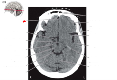 <p>separates the two cerebral hemispheres</p>