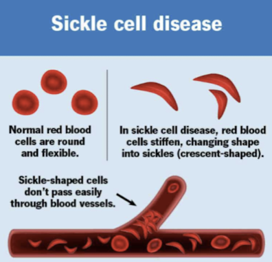 <p>Sickled red blood cells obstruct venous drainage from the corpora cavernosa, causing blood to become trapped and resulting in prolonged painful erection.</p>