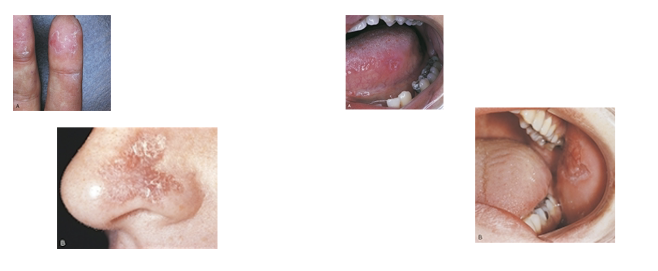 <p>Systemic Lupus Erythematosus</p>