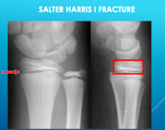 <p>salter harris I fracture (hard to identify on xray)</p>