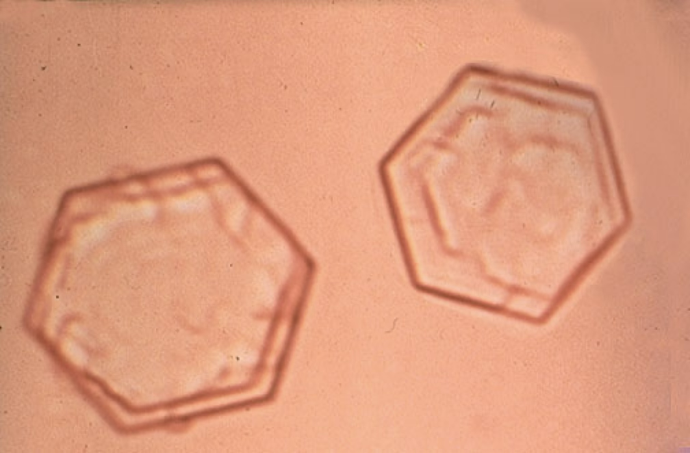 <ul><li><p>Typically seen in a cidic urine.</p></li><li><p>Appear flat and 6-sided (hexagonal).</p></li><li><p>Can be associated with renal tubular dysfunction or cystine urolithiasis.</p></li></ul><p></p>