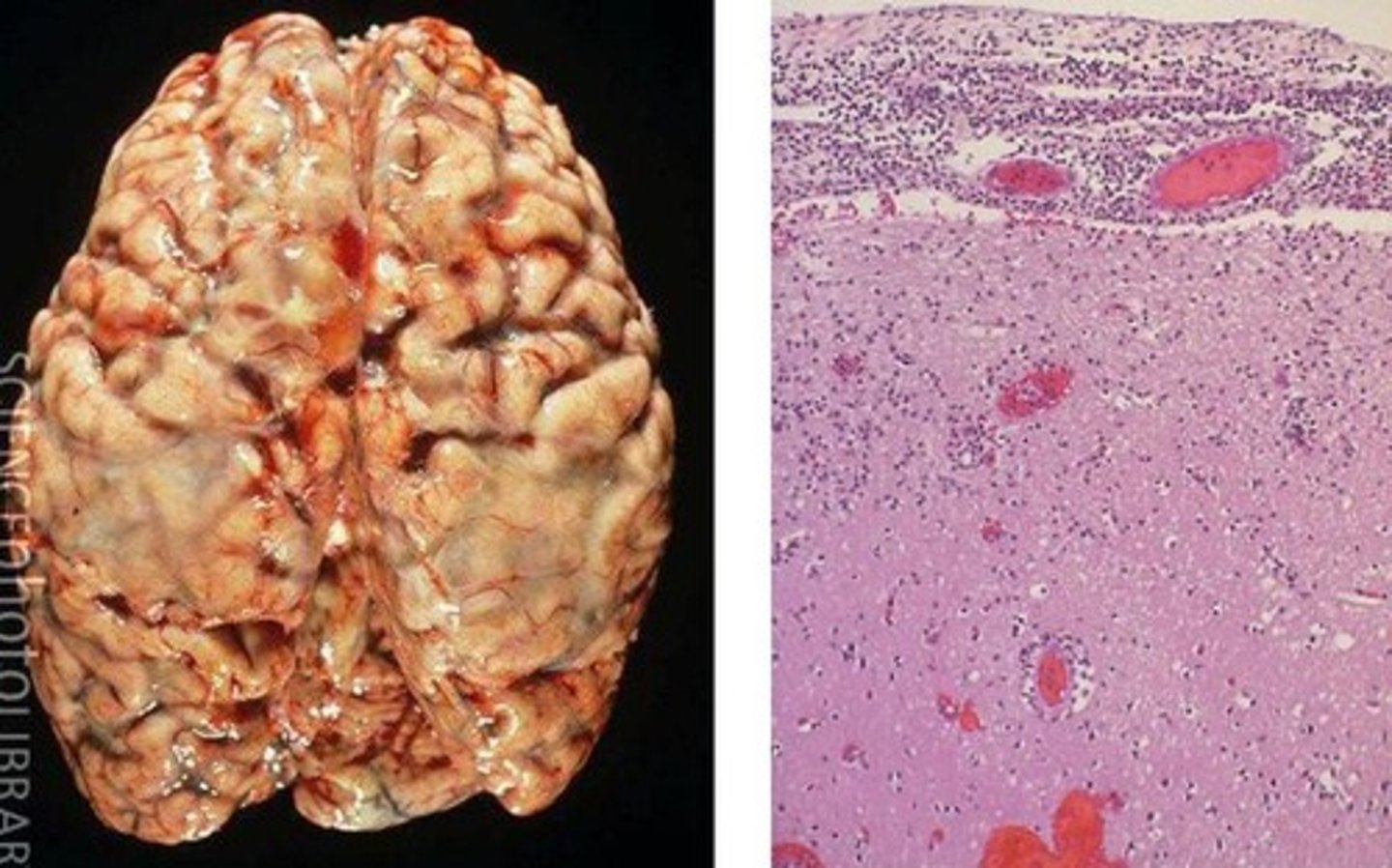 <p>A bacterial infectious disease that affects humans.</p><p>- Infects the membrane around brain & spinal cord (meninges), causing brain and nerve damage</p><p>- Diagnosed with blood test or lumbar puncture</p><p>- Treated with antibiotics</p>