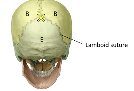 <p>Parietal and Occipital bone</p>