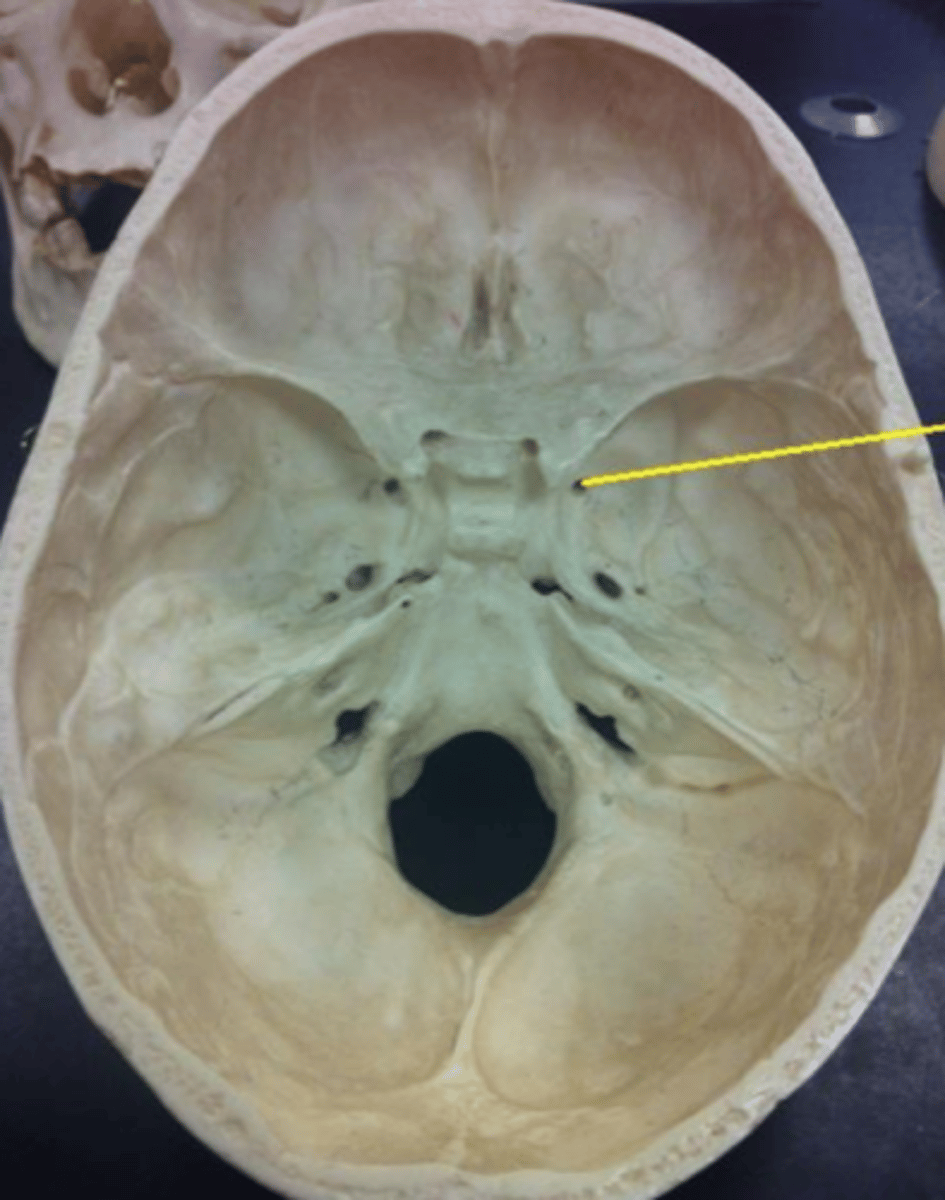 <p>Skull Opening: </p><p>Foramen rotundum -> infraorbital foramen </p><p>Muscle Group: </p><p>Sensory</p><p>Main Function:</p><p>Midface sensation</p><p>Clinical Correlation: </p><p>Facial fracture</p><p>Classic Symptoms:</p><p>Numb cheek &amp; upper lip </p>