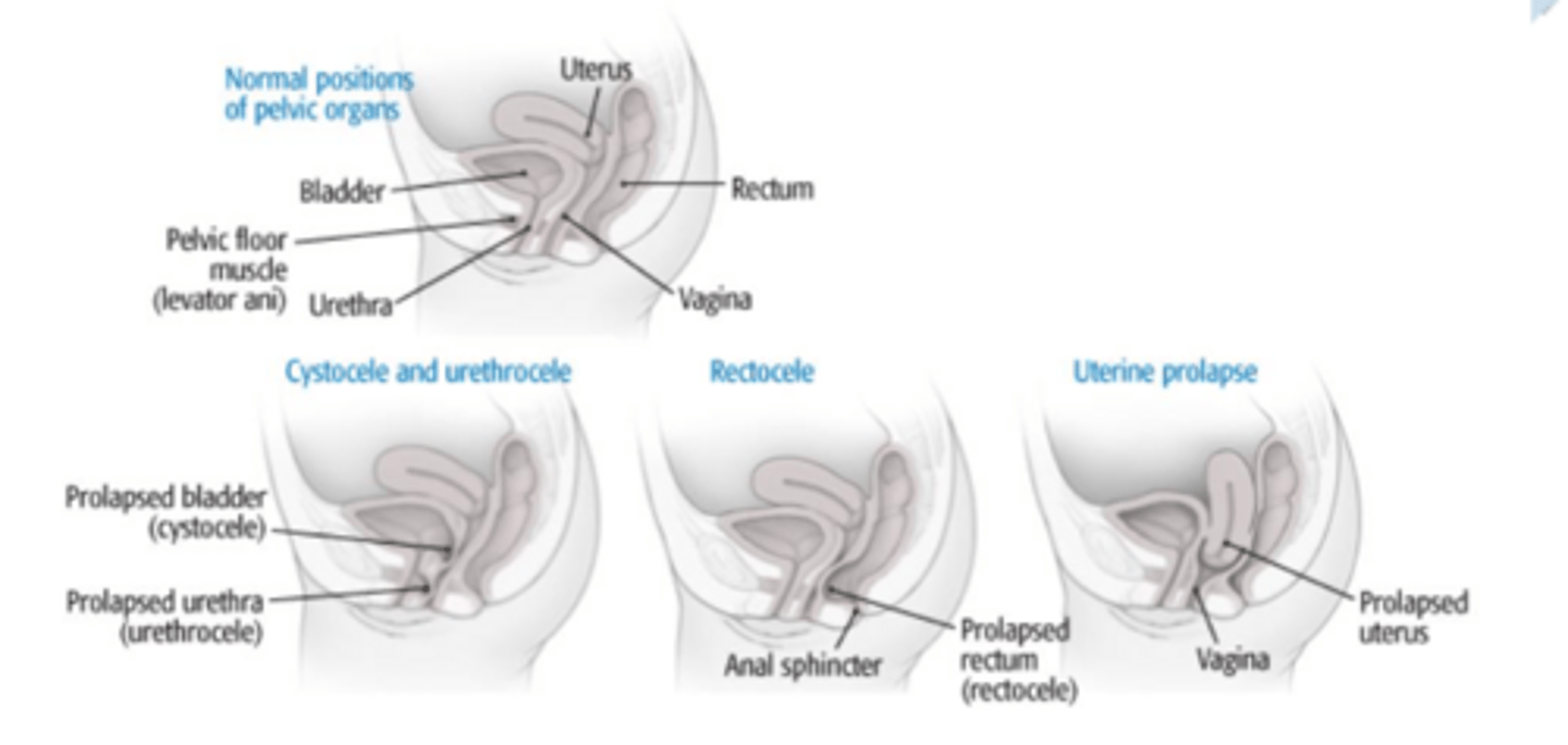 <p>Uterine Prolapse- bulging uterus into the vagina</p><p>Signs & symptoms:</p><p>• Pelvic pressure, perineal heaviness, backache</p><p>• Symptoms relieved by lying down</p><p>• Symptoms made worse by prolonged standing, walking, coughing, or straining</p><p>Cystocele Prolapse- herniation of bladder into the vagina</p><p>Signs & symptoms:</p><p>• Urinary frequency and urgency</p><p>• In advanced stages, difficulty emptying the bladder</p><p>• Cystitis (bladder infection)</p><p>• Bulge or pressure sensation in the perineal area</p><p>• Urinary incontinence</p><p>Rectocele Prolapse- herniation of rectum into the vagina</p><p>Signs & symptoms:</p><p>• Perineal pressure and bulge</p><p>• Straining to defecate</p><p>• Feeling of incomplete rectal emptying</p><p>• Constipation</p>
