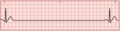 <p>A break in the normal EKG pattern, SA node fails to fire</p>