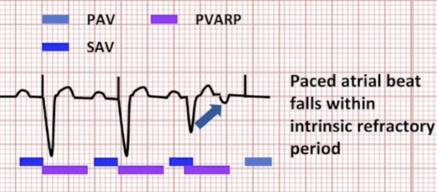 <ul><li><p>Fast atrial pacing rate causes atrial paced beat to land within intrinsic refractory period: functional non-capture</p><ul><li><p>Sensor-indicated rate</p></li><li><p>High base rate</p></li><li><p>Atrial overdrive pacing</p></li></ul></li></ul><p></p>