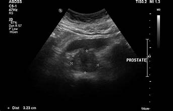 <p>Is this a normal or abnormal prostate image?</p><p> </p><p>a. normal</p><p> </p><p>b. abnormal</p>