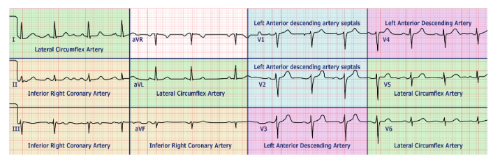 <p>A 62-year-old man presents to the emergency department with sudden-onset substernal chest pain and diaphoresis beginning 45 minutes ago. His 12-lead ECG is shown, with each lead color-coded to its corresponding coronary artery territory. Using the ECG, which waveform finding in the leads mapped to the inferior right coronary artery territory is most consistent with an acute myocardial infarction in that region?</p>