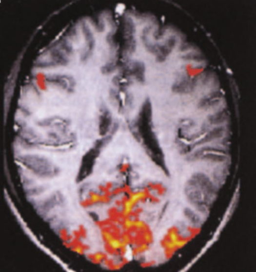 <p>works similar to regular MRI but uses hemoglobin to look at oxygen metabolism over time as an indirect measure of neural activity, 4D image where the fourth direction is time (before and after stimulus is present), active neurons consume more oxygen than those at rest</p><p>limitations: slower temporal resolution (4-8s delay), limited spatial resolution, extreme sensitivity to subject motion, expensive</p>