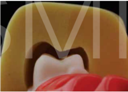 <p>pripomoček iz odtisa začetne oblike in dimenzije zoba - preverjamo, ali je bilo odstranjenega dovolj zobnega tkiva</p>