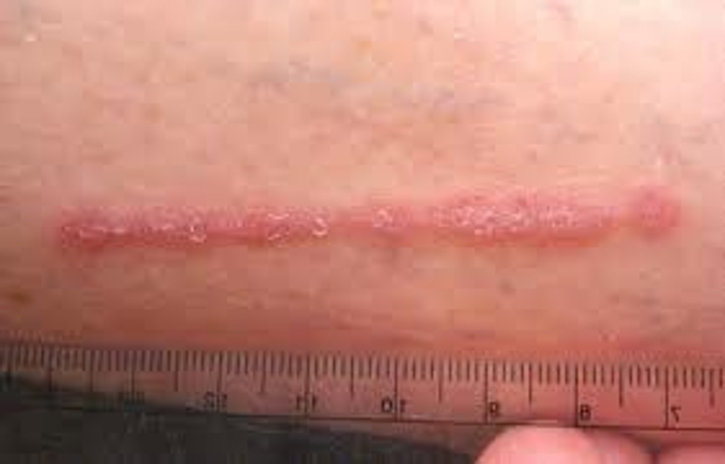 <p>It is a mark on the skin that may indicate an injury or damage that changes the structure of tissue or organ.</p>