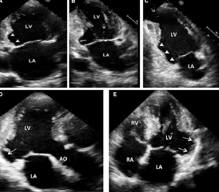 <p>Chronic cardiomyopathy caused by infection with a parasite</p>