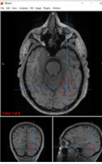 <p>inferior temporal gyrus</p>