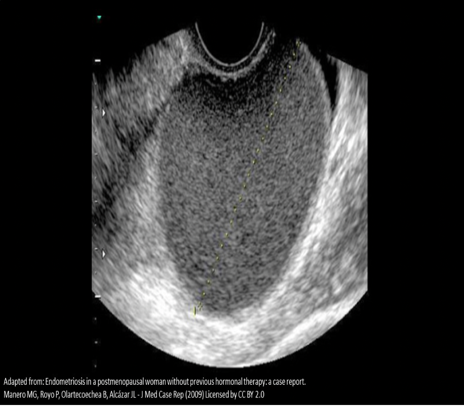 <p>A 20 year old female complains of dysmenorrhea and menorrhagia. She states her menstrual cycle occurs every 28 days and her LMP was 21 days ago. The image displayed is from the transvaginal scan performed for this patient. Which of the following is the most likely diagnosis for the findings displayed?</p><p>A. Adenocarcinoma</p><p>B. Pyosalpinx</p><p>C. Endometrioma</p><p>D. Hematometrocolpos</p>