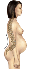 <p>An exaggerated anterior deviation of the normal lumbar curvature (i.e., an over-accentuated secondary curve), producing a pronounced inward "swayback" appearance of the low back.</p>