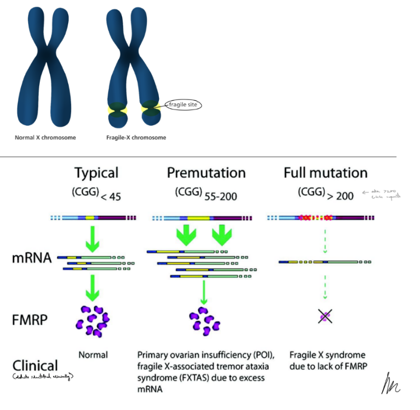 <p>fragile X syndrome is the most common <u>hereditary</u> cause of ID and ASD</p><p>a <span style="color: blue;">trinucleotide repeat expansion disease of <u>CGG</u></span></p><ul><li><p>is caused by <u>gene </u><strong><u>mutation </u></strong><u>of gene </u><strong><u>FMR1</u></strong> that encodes for the <strong><u>Fragile X Messenger ribonuclear protein (FMRP),</u></strong> SO have <strong><u>lack of FMRP expression</u></strong></p><ul><li><p>^ the lack of FMRP protein expression is what causes Fragile X syndrome</p></li></ul></li></ul><p><u>typical </u>(→ get <strong>normal FMRP expression</strong>), <u>premutation </u>(→ have <strong>some defects</strong>), <u>mutation </u>(→ <strong>lack of FMRP expression</strong>) </p><p>symptoms:</p><ul><li><p>ASD</p></li><li><p>ID</p></li><li><p>enlarged testicle</p></li><li><p>flat feet</p></li><li><p>seizures (in ~10% of patients)</p></li></ul><p></p>