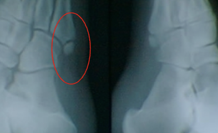 <p>what type of fracture?</p>