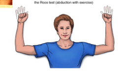 <p>90° abduction/ER, 90° elbow flexion, open/close hands for 3 minutes; checks thoracic outlet.</p>