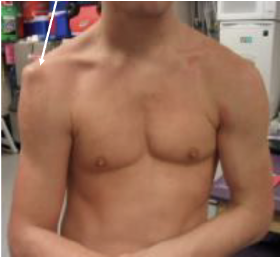 <p><span>An abnormal visible depression below the acromion associated with </span><strong>glenohumeral joint dislocation</strong><span>. The lecture illustrates this with an acromion appearing displaced in a dislocated shoulder</span></p>
